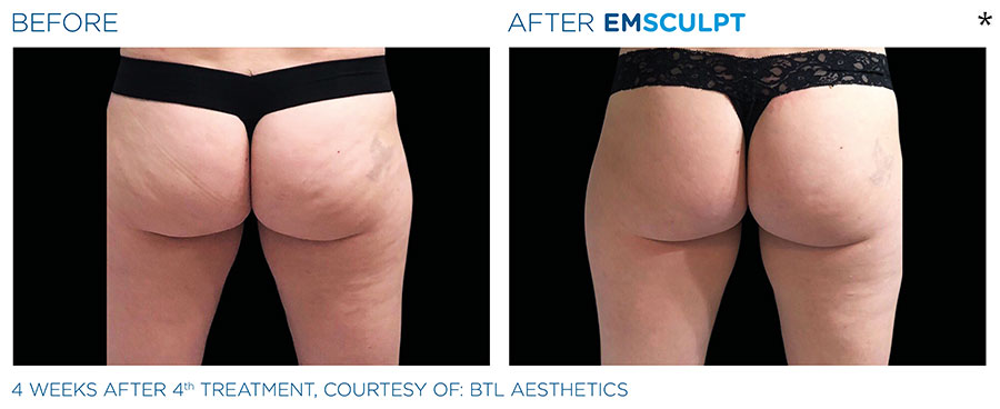 Before and After Photo of Butt Lift Treatment in Merrimack